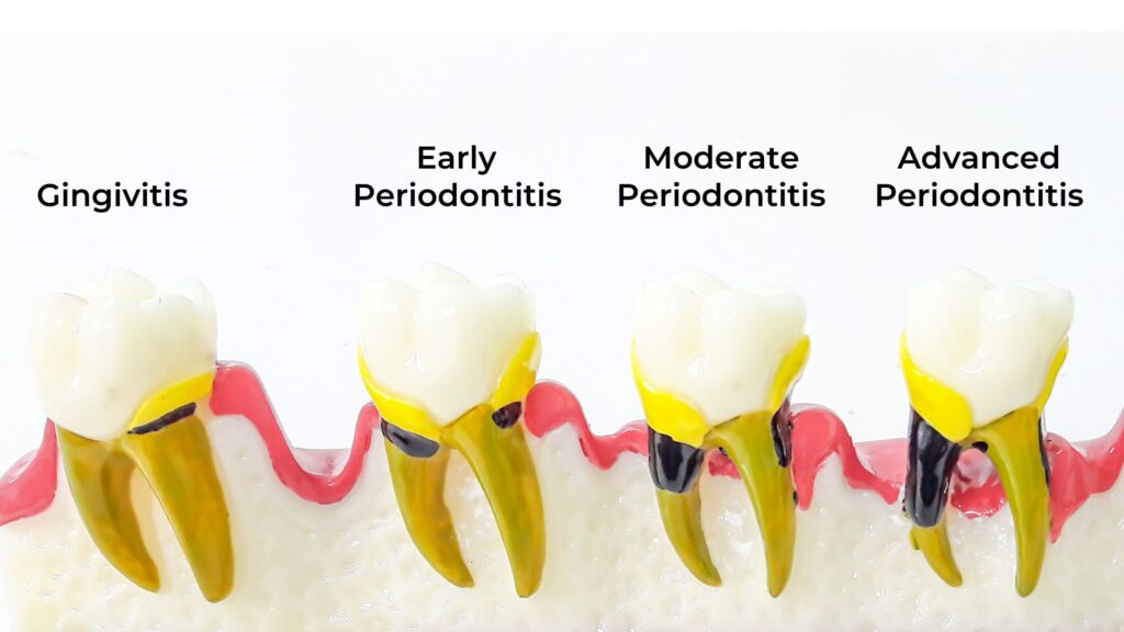 gindivitis-and-3-stages-of-periodontitis-swedish-dental-1024×576